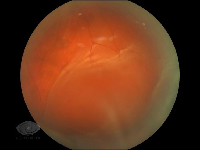 Мерцание в глазах и головная боль. Мерцание в глазах остеохондроз, мерцание в глазах причины,блики в… — иллюстрация 6