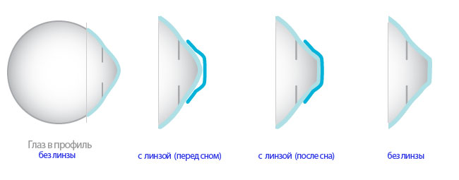 Контактные линзы для глаз — иллюстрация 4